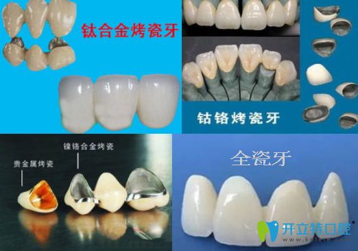 談各種常見烤瓷牙的優(yōu)缺點(diǎn)及價(jià)格