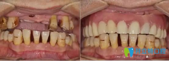 美奧口腔ALL-ON-4半口種植牙前后對比效果