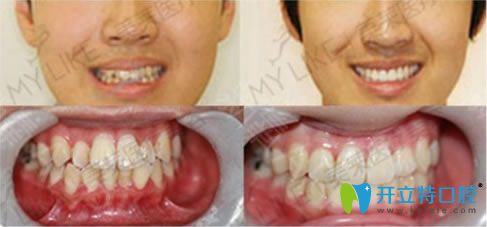 20歲顧客齙牙矯正前后對(duì)比案例