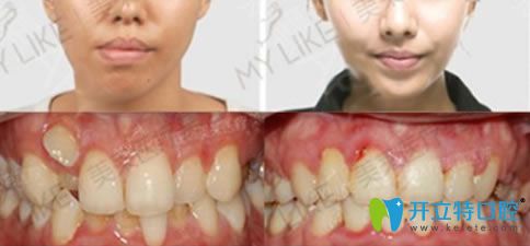 30歲顧客牙齒擁擠+畸形牙矯正案例對(duì)比圖