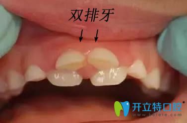 兒童乳牙滯留造成雙排牙的圖片