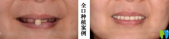 西安海濤allon4全口種植牙真實(shí)<span style=