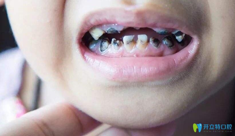 為了不后悔建議看小孩牙齒爛掉了怎么辦此文