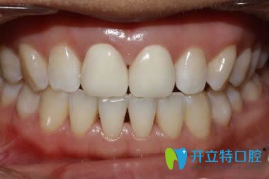二氧化鋯全瓷牙口腔修復(fù)圖