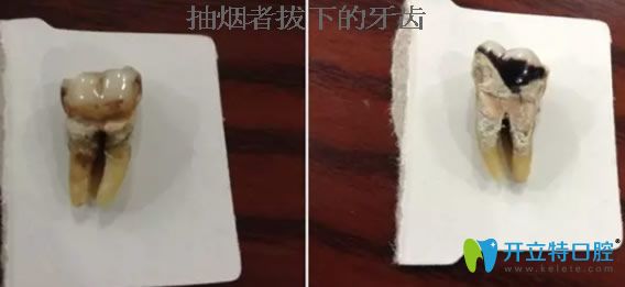 抽煙者拔下的牙齒
