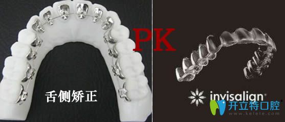 隱適美矯正和舌側(cè)矯正哪個(gè)好