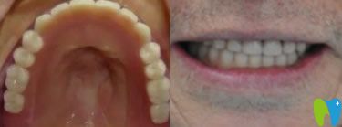 老爸在寧波牙博士口腔做半口種植牙后