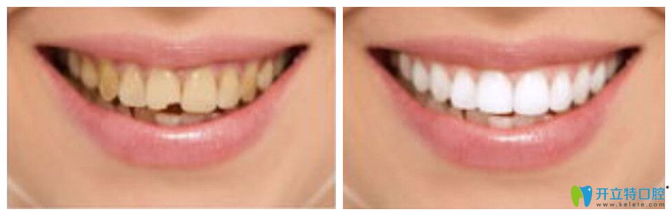 鑄瓷牙容易碎裂嗎