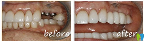吉林愛齒口腔種植牙前后對(duì)比圖 吉林愛齒口腔種植牙前后對(duì)比圖