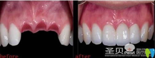 成都圣貝30歲顧客門牙缺失種植前后對比效果