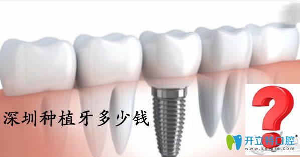 公布深圳種植牙價格表及當?shù)卣?guī)的十大種植牙醫(yī)院排名