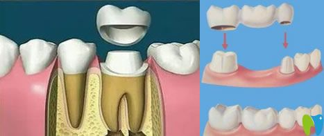 臨時(shí)牙冠能戴多久,掉了怎么辦？