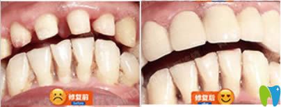 何靜全科醫(yī)生烤瓷牙修復(fù)前后對(duì)比效果