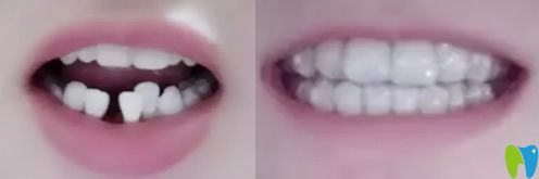 淄博海全口腔隱形牙齒矯正案例