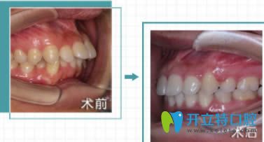 福州維樂口腔許長(zhǎng)記醫(yī)生成人齙牙矯正前后對(duì)比照