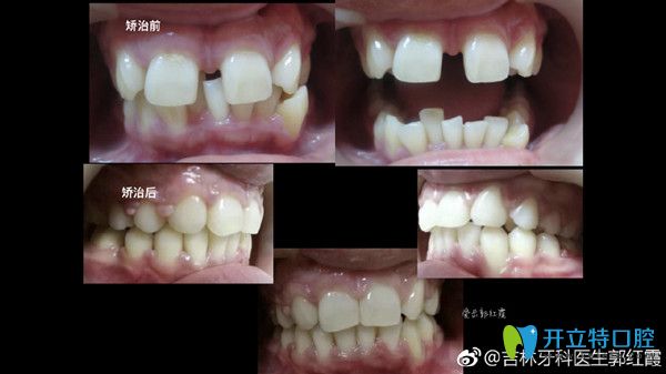牙齒縫隙過大矯正前后對(duì)比圖