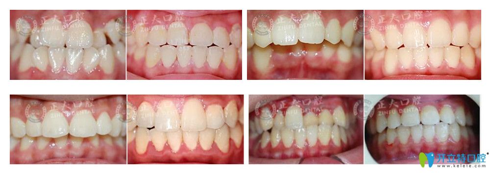 深圳正夫口腔徐國強(qiáng)lh魔法絲矯正案例效果對比圖