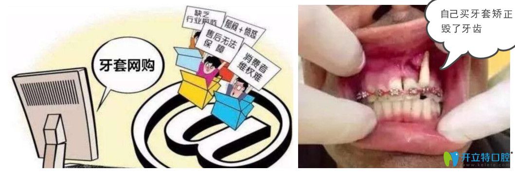 齙牙自己在家矯正的方法