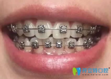 我在昆明王巍口腔矯正戴牙套第9個月 我在昆明王巍口腔矯正戴牙套第9個月