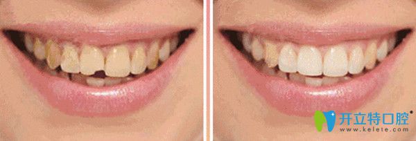 輕度牙齒缺損修復后對比照