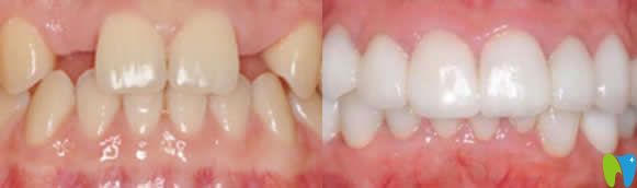 安植雅口腔微創(chuàng)種植效果 安植雅口腔微創(chuàng)種植效果