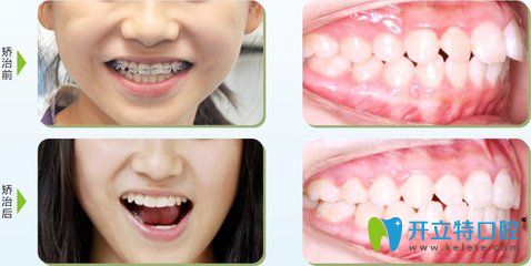 南昌安植雅口腔兒童牙齒矯正案例 南昌安植雅口腔兒童牙齒矯正案例