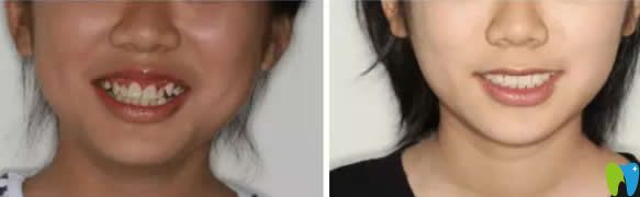 安植雅口腔隱形牙齒矯正前后對(duì)比圖 安植雅口腔隱形牙齒矯正前后對(duì)比圖