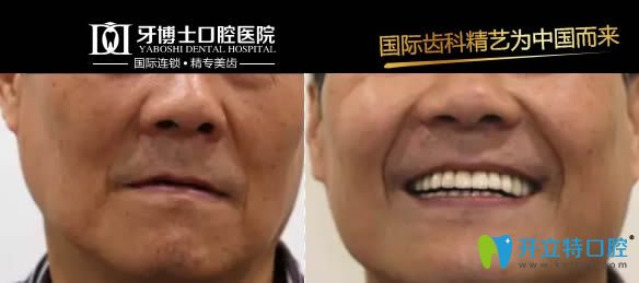 重慶牙博士瑞士iti親水種植牙案例對比圖
