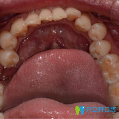 牙齒缺失前的照片 牙齒缺失前的照片