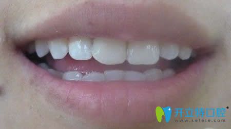 我在淄博海全口腔做牙齒瓷貼面修復(fù)后照片