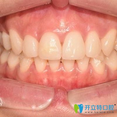 即刻種植牙前后對比照 即刻種植牙前后對比照