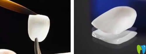 我在淄博海全口腔做超薄瓷貼面修復(fù)