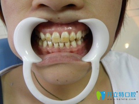 扒了多種牙齒美白方法,我選擇做超薄牙齒貼面修復氟斑牙