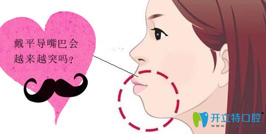 戴了平導(dǎo)上牙越來(lái)越突