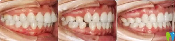 隱形牙齒矯正治療前后變化圖 隱形牙齒矯正治療前后變化圖