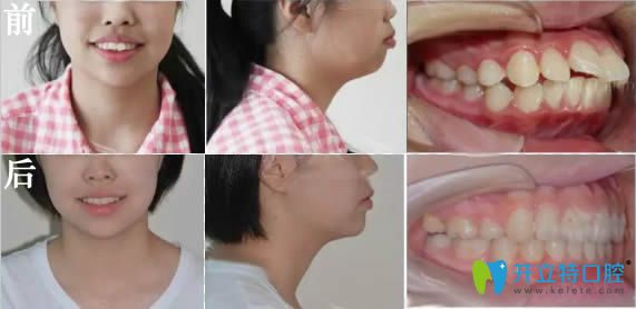 成人前牙深覆蓋矯正臉型變化對比照