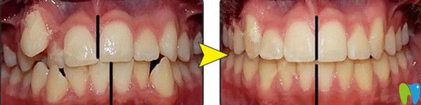 金屬托槽矯正前后對比圖 金屬托槽矯正前后對比圖