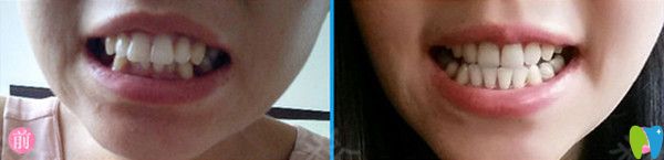 牙齒矯正前后對比圖