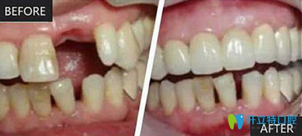 即刻種植前后變化圖