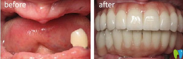 泰州北極星口腔怎么樣？看全口種植牙案例