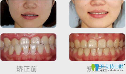 維樂口腔王燕燕青少年地包天矯正案例效果