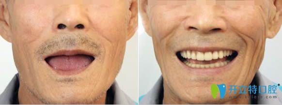 泉州維樂謝燕峰醫(yī)生3D數(shù)字導板全口種植牙對比效果