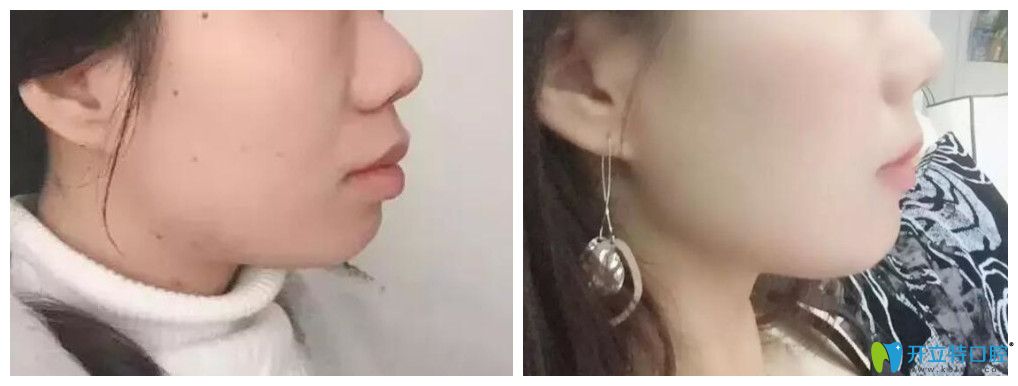 艾芳口腔嘴突齙牙顧客矯正案例前后對比圖