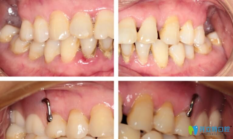 維他靈支架真實病例對比