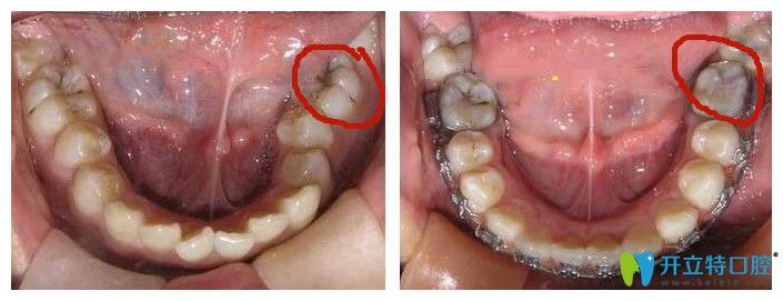 鎖合牙矯正對(duì)比圖