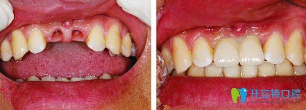 美學(xué)種植牙修復(fù)前后效果圖