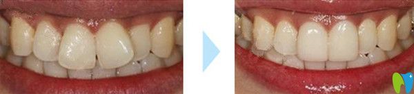 前牙美容冠修復(fù)比對(duì)圖