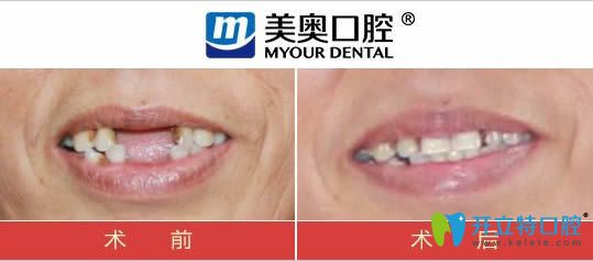 杭州美奧口腔多顆牙缺失種植案例對(duì)比圖
