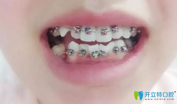 中山禾佳口腔剛戴上牙套樣子