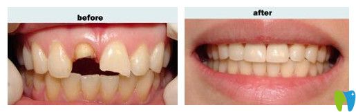 重慶鵬博口腔陳亮醫(yī)生前牙缺損修復(fù)效果 重慶鵬博口腔陳亮醫(yī)生前牙缺損修復(fù)效果